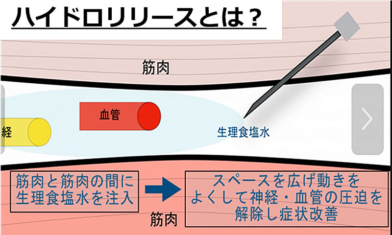 ハイドロリリースとは?
